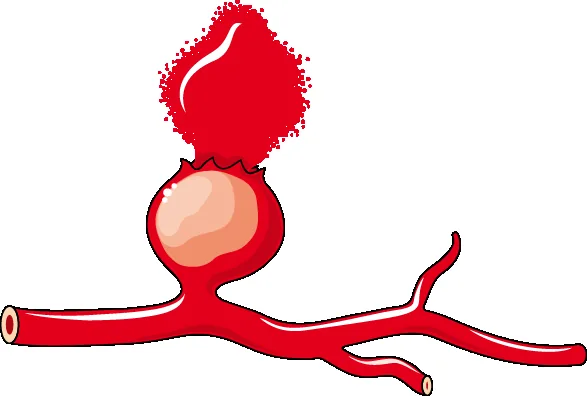 Ilustração de aneurisma cerebral roto, com extravasamento de sangue