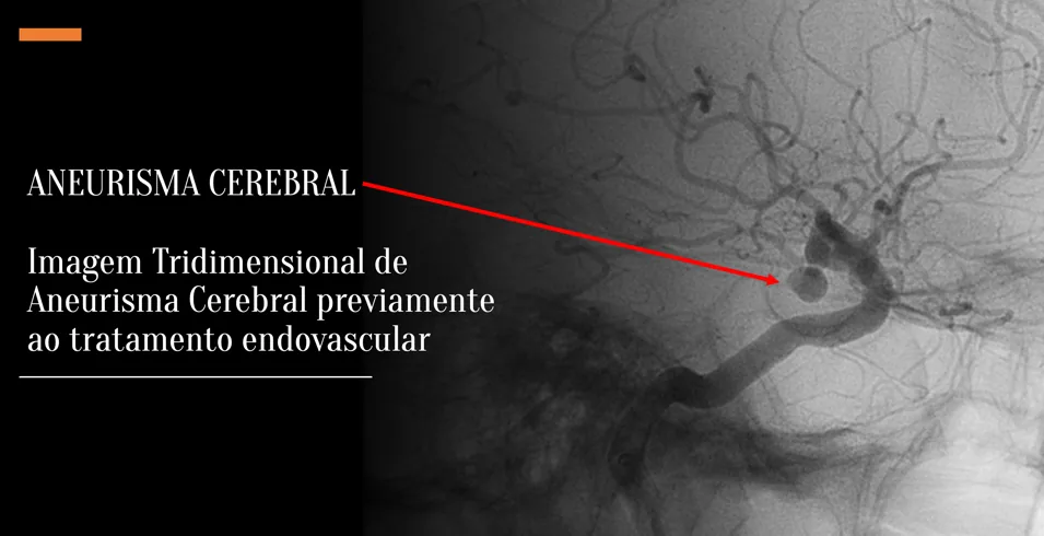 Imagem tridimensional de aneurisma cerebral antes do tratamento endovascular