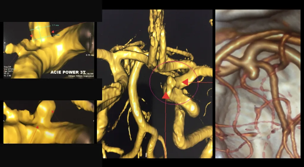 Angiotomografia intracraniana com reconstrução tridimensional de aneurismas cerebrais