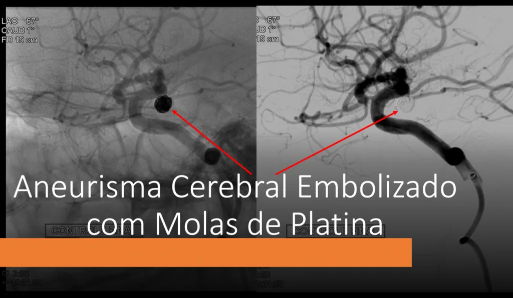 Angiografia de aneurisma cerebral embolizado com molas de platina