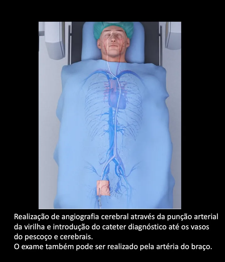 Ilustração da angiografia cerebral: cateter introduzido pela artéria da virilha até os vasos do pescoço e do cérebro