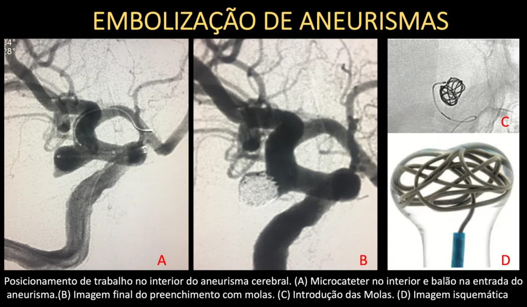 Etapas da embolização de aneurisma: microcateter no interior, preenchimento com molas e imagem final