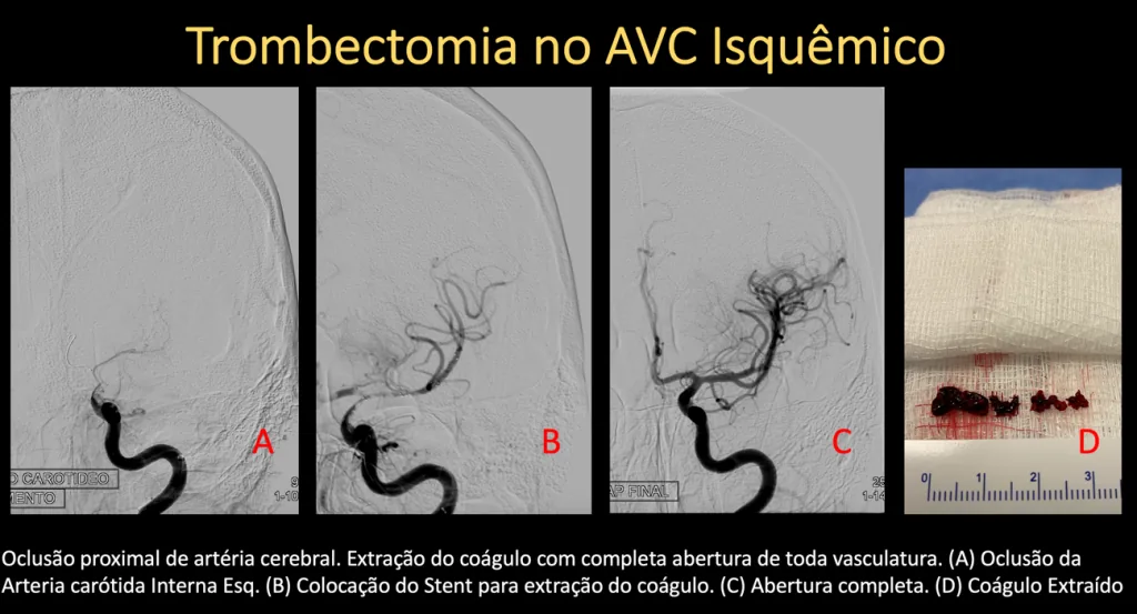 Trombectomia no AVC isquêmico: oclusão da artéria, colocação do stent e coágulo extraído