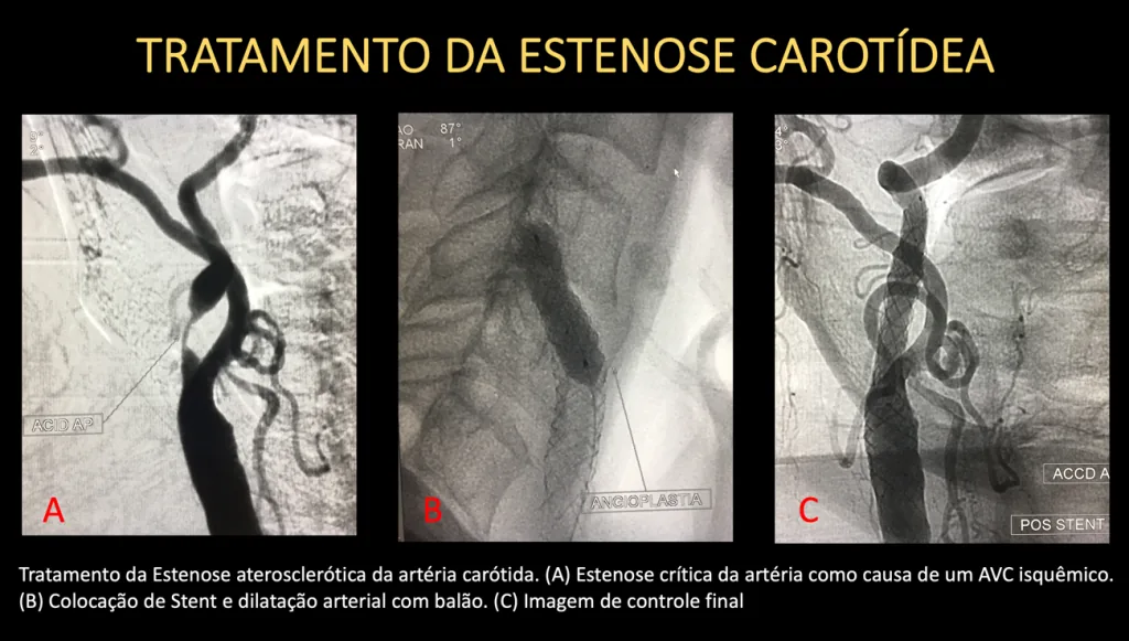 Tratamento da estenose carotídea: estenose crítica, colocação de stent e imagem de controle
